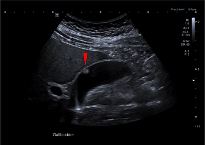 Epehólyag polyp